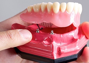 full denture being placed on a model of the jaw 