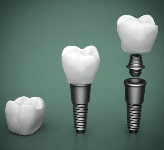 dental implant crown, abutment, and post 