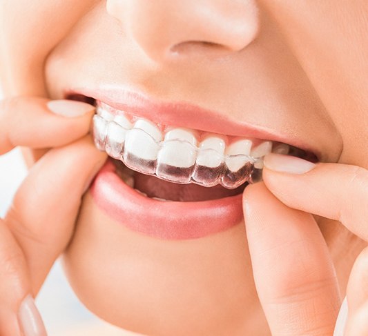 Closeup of how Invisalign in Raleigh works 