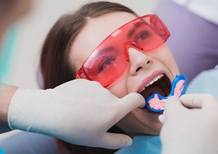 Young woman in dental chair as gloved hands placing fluoride tray over her upper arch