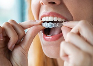 a woman putting clear aligners over the top arch of her teeth