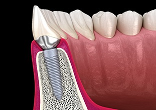 Illustration of dental implants in North Raleigh, NC after osseointegration