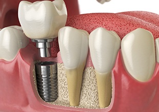 Dental implant in Raleigh, NC having a crown placed