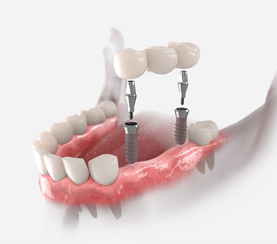 a digital illustration showing an implant bridge