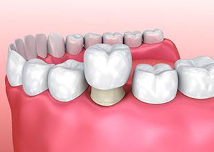 A single dental crown in North Raleigh, NC on tooth