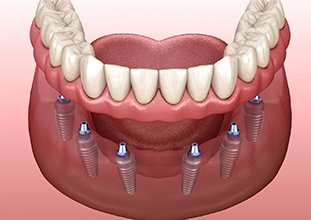 Computer illustration of partial dentures in Raleigh, NC