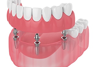 Digital illustration of implant denture in North Raleigh