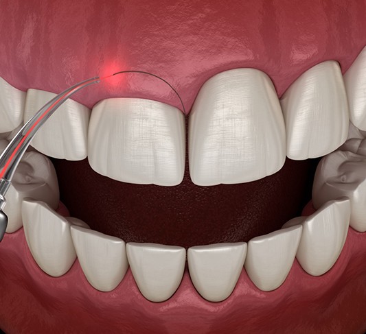 Illustration of dental instrument performing gum recontouring in Raleigh