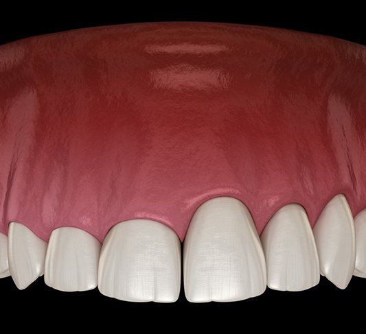 Illustration of teeth with uneven gumline