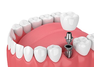 3D illustration of single dental implant