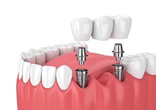 3D illustration of dental bridge 