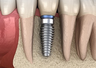 single dental implant in the jaw 