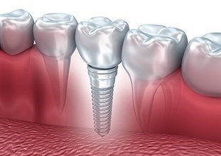 single dental implant post in the bottom jaw 