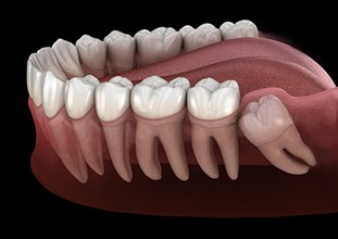 Illustration of impacted wisdom tooth in gum tissue