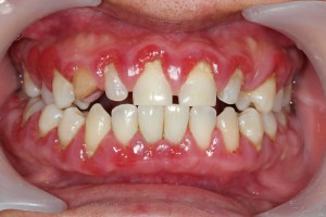 Gum disease treatment in North Raleigh can save your healthy teeth and gums. 