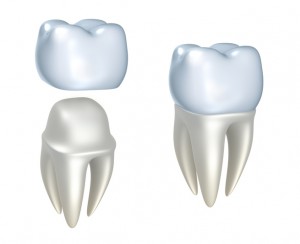 Your dentist in North Raleigh provides high-quality dental crowns. 