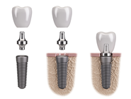 Illustration of dental implant components