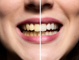 before and after teeth whitening