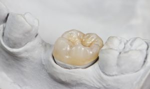 tooth-colored ceramic restoration crown