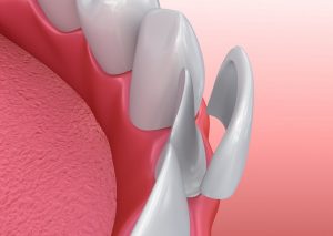 An illustration of porcelain veneers.