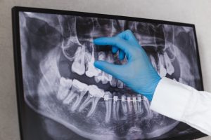 dentist pointing to an X-ray