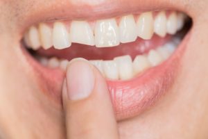 Chipped tooth needs treatment from North Raleigh emergency dentist