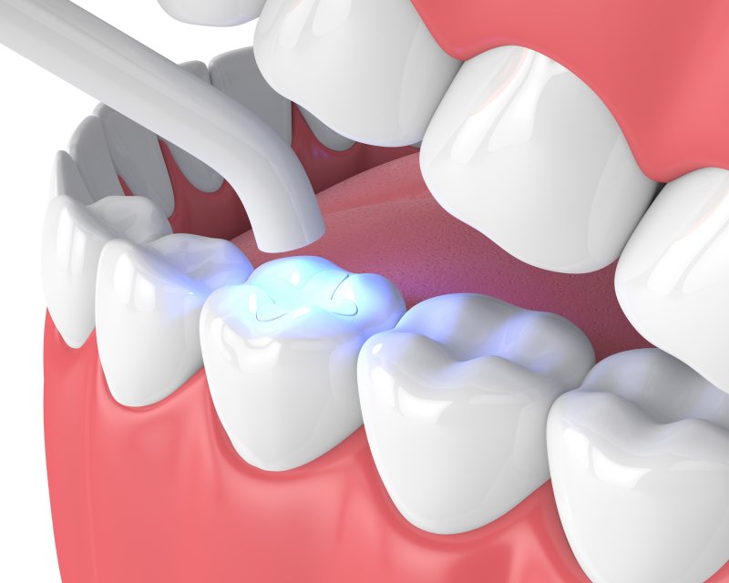 a digital image of a tooth-colored filling and a curing light to harden the resin