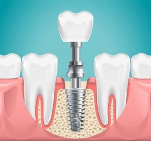 Image of missing tooth being replaced by a dental implant.