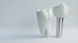 Dental implants against a white background.