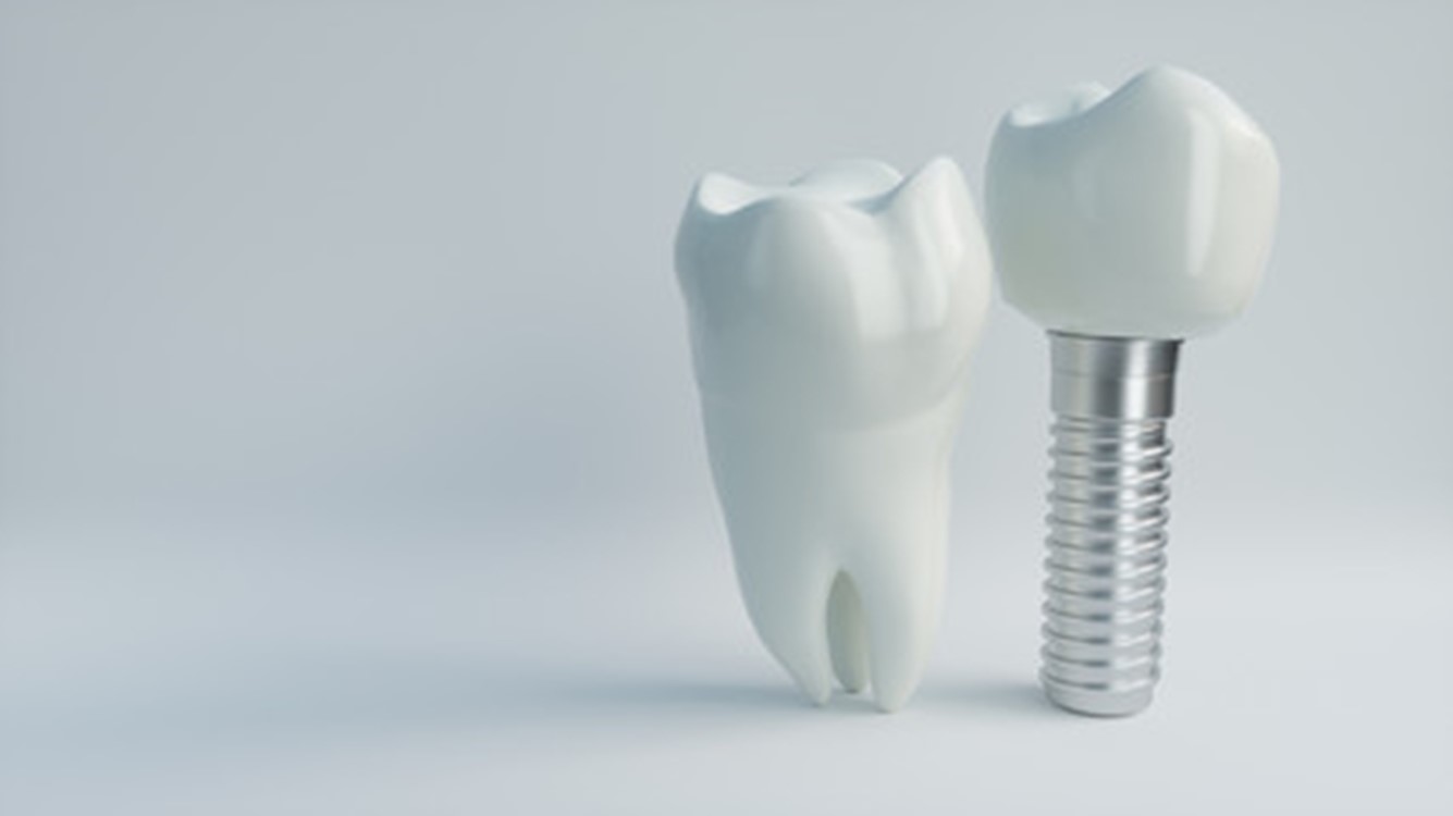 Cost Of Dental Implants Raleigh Dentist Dr. Philip A. Lisk