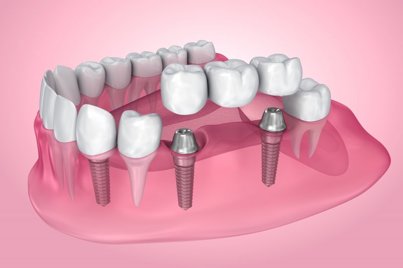 Illustration of dental implants with bridge